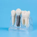 Implanty zębów Wrocław
